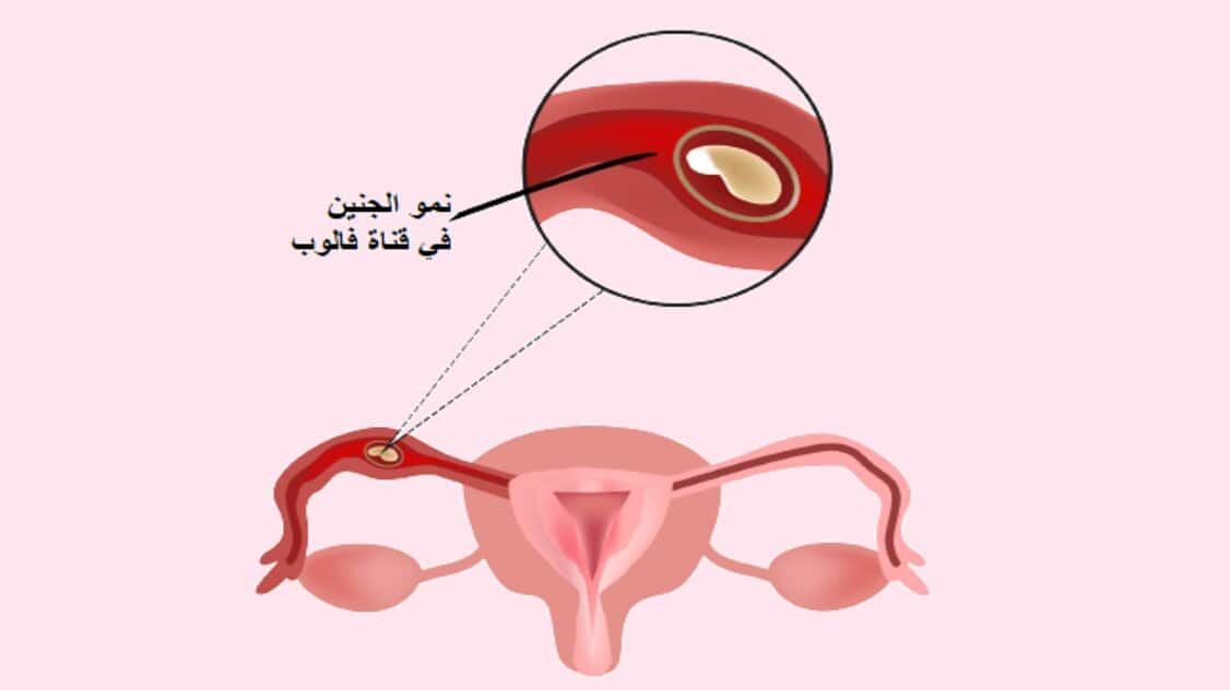 ما هو الحمل خارج الرحم؟ لماذا يحدث؟ الأعراض والعلاج