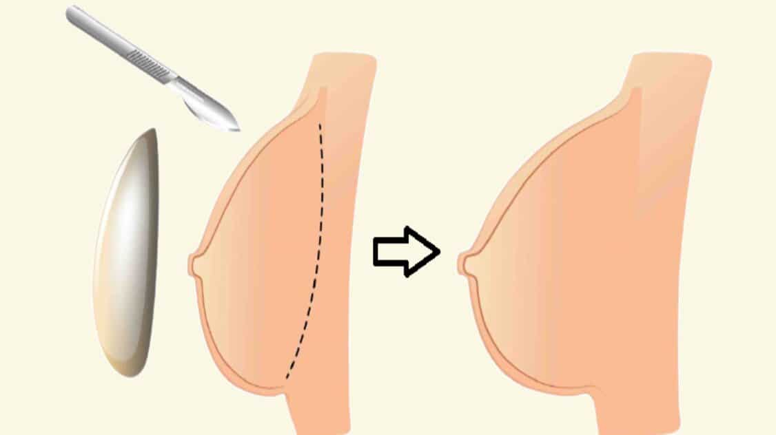 كيف تجرى عملية تكبير الثدي ؟ طرق تكبير الثدي
