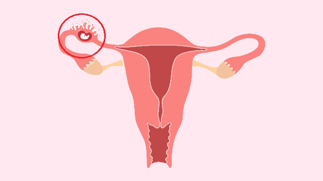 ما هو الحمل خارج الرحم؟ لماذا يحدث؟ الأعراض والعلاج